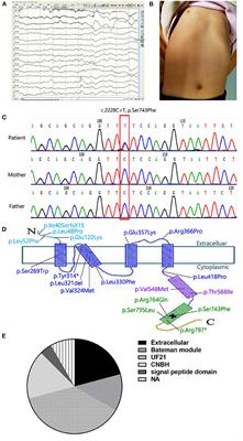 Case Report: CNNM2 Mutations Cause Damaged Brain Development and Intractable Epilepsy in a Patient Without Hypomagnesemia